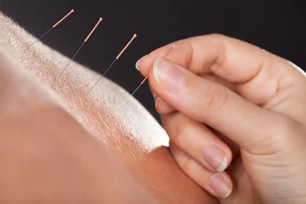 Acupuncture Image
